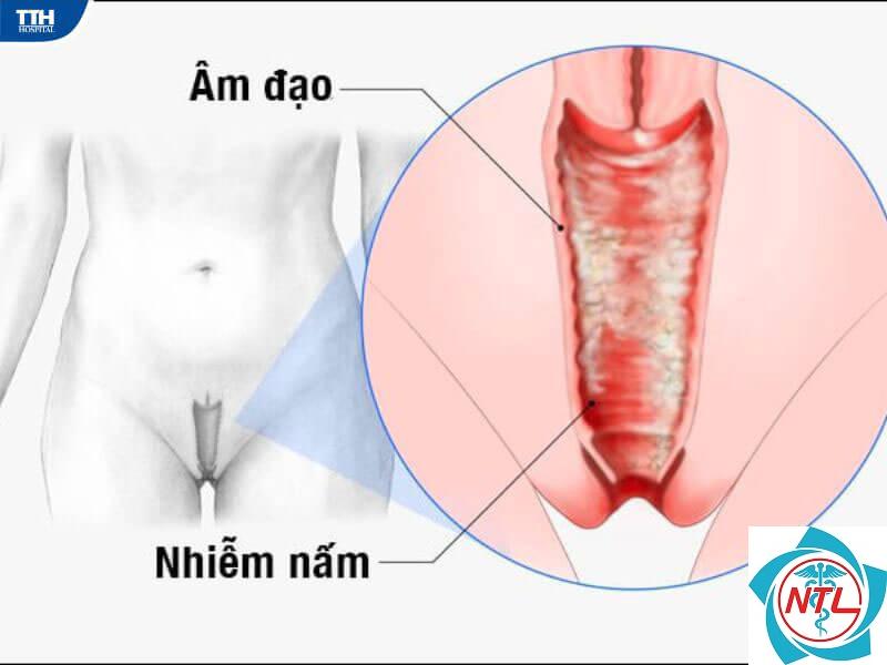 nấm candida vùng bẹn - Image 3