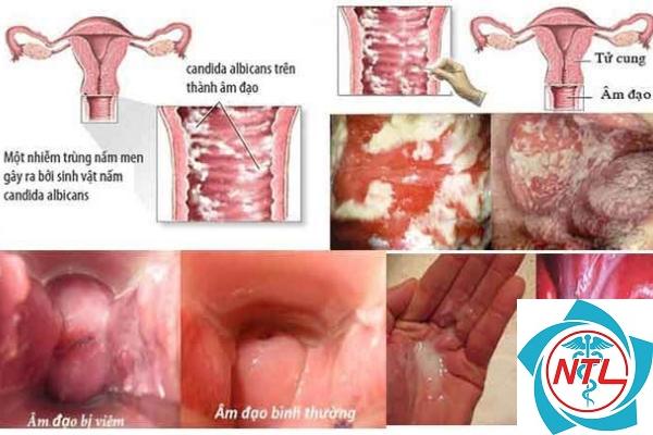 nấm candida vùng kín - Image 3