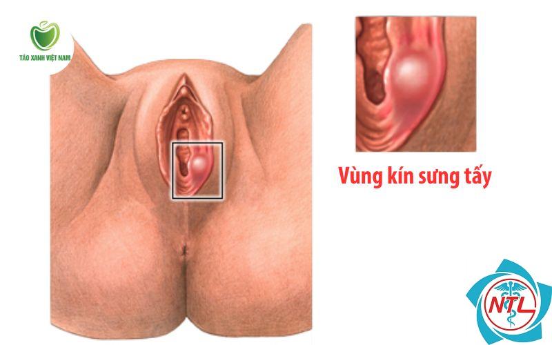 nấm candida vùng kín - Image 4
