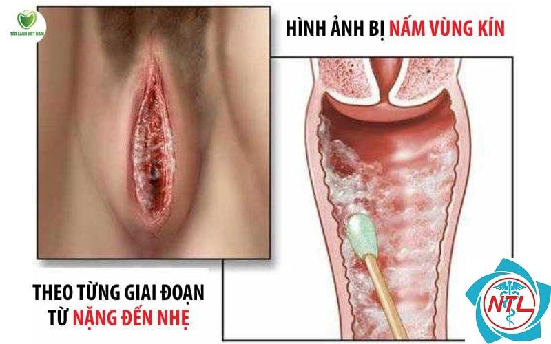 nấm candida vùng nếp gấp - Image 2