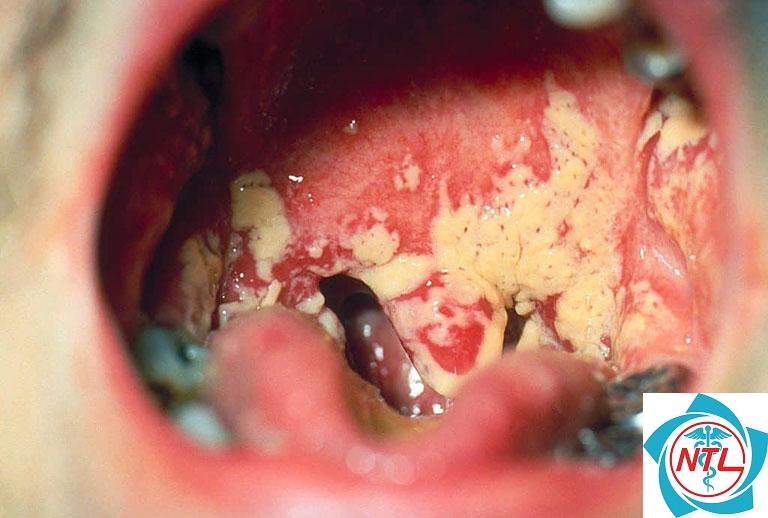 nấm candida vùng nếp gấp - Image 3