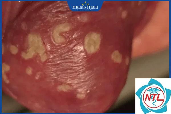 nấm candida vùng nếp gấp - Image 4
