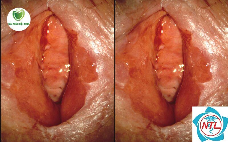 nấm candida vùng nếp gấp