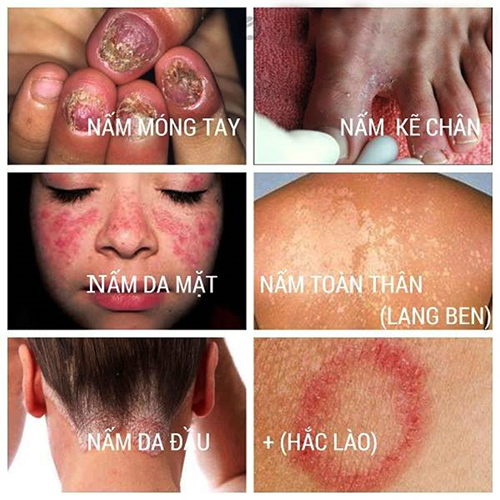 nấm da - Image 3