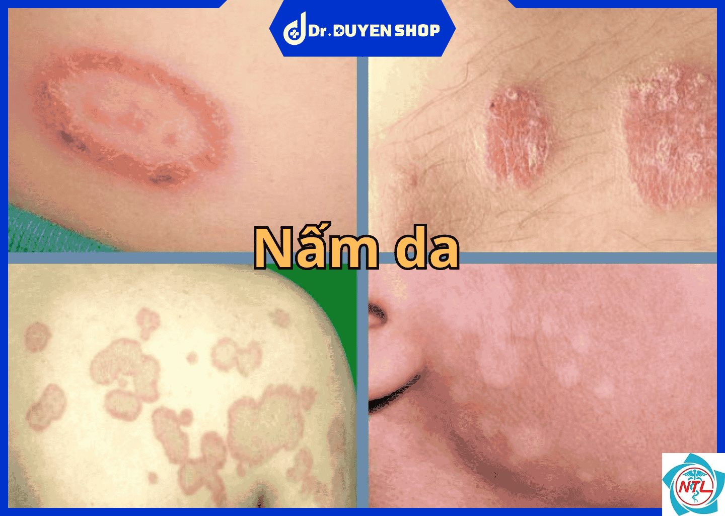 nấm da corporis - Image 2