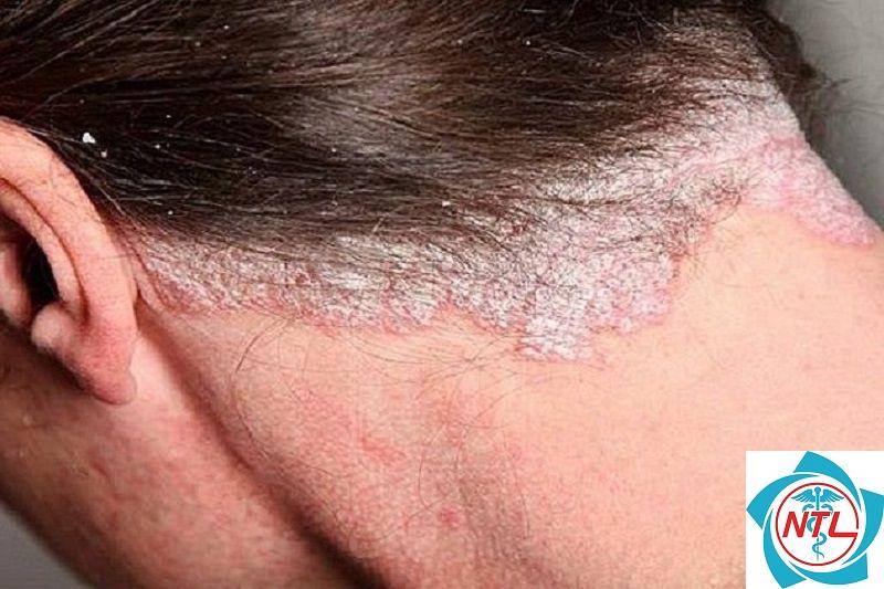 nấm da đầu dạng mảng