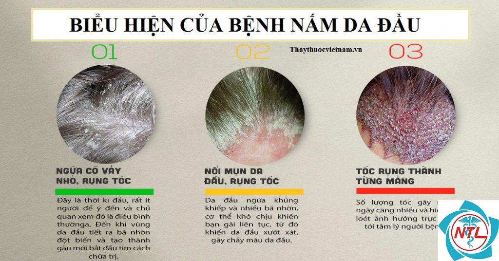 nấm da đầu do nấm - Image 3