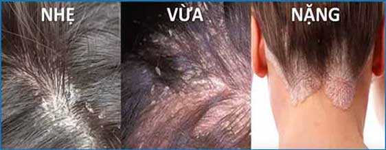 nấm da đầu ở người lớn - Image 3