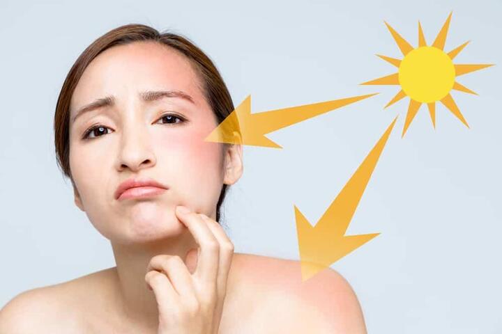 nám da do ánh nắng