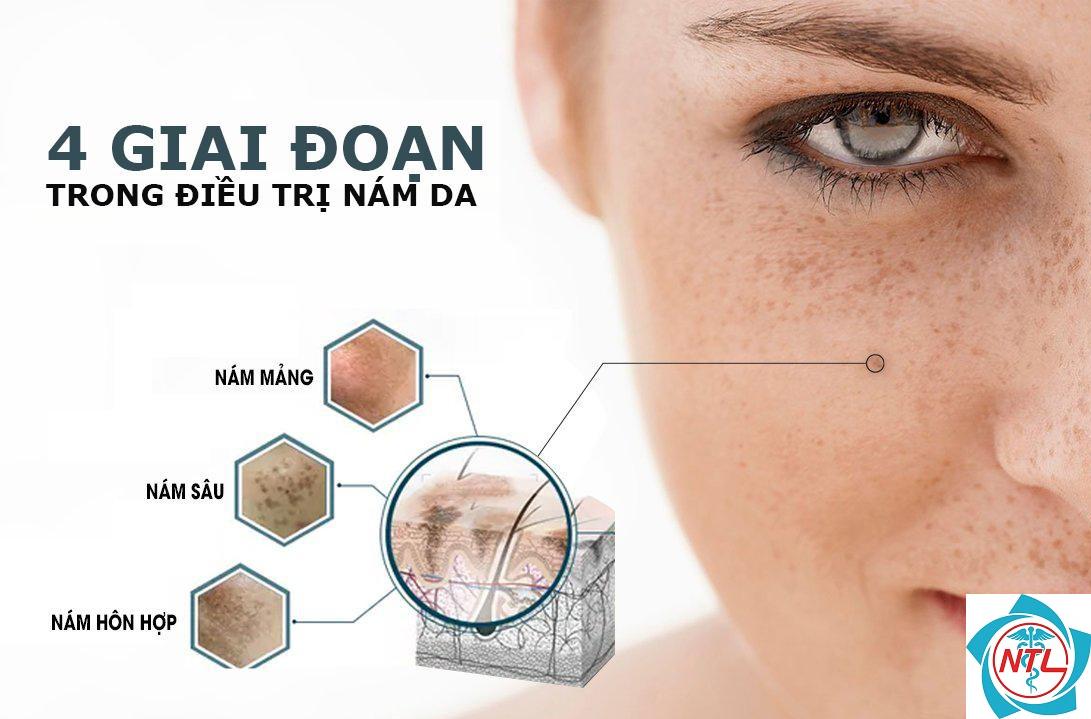 nám da do thuốc - Image 2
