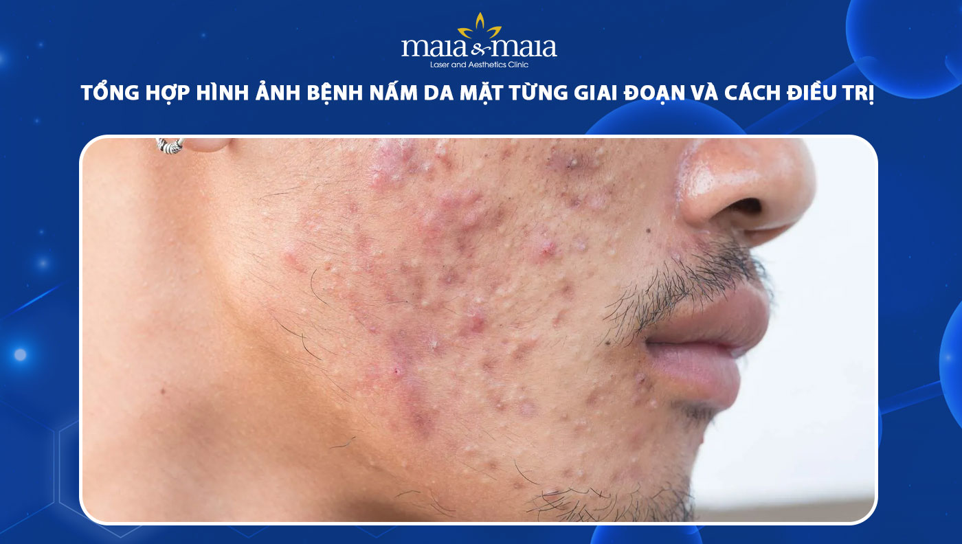 nấm da mặt - Image 3