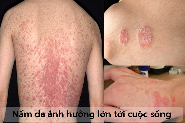 nấm da ở người lớn - Image 3