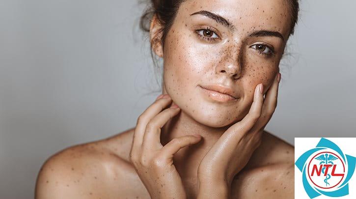 nám da ở người trẻ