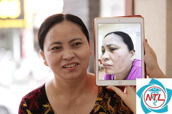 nám da ở phụ nữ trung niên - Image 3