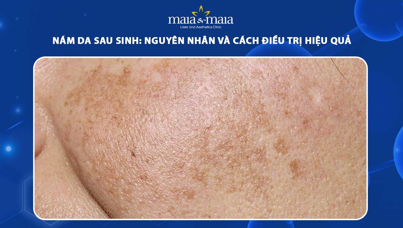 nám da sau sinh - Image 4