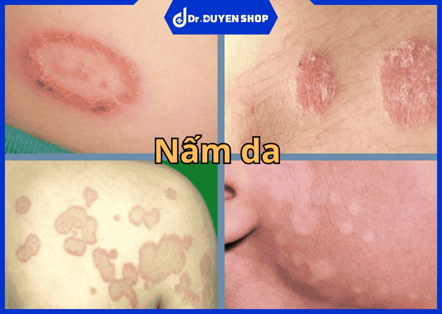 nấm da tái phát - Image 4