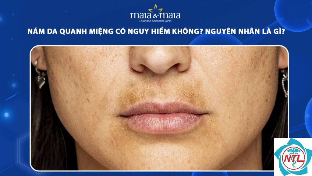 nám da vùng cằm - Image 3