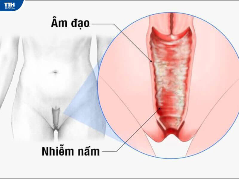 nấm da vùng kín - Image 3