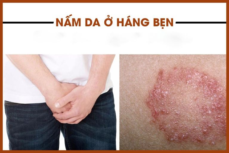 nấm háng - Image 2