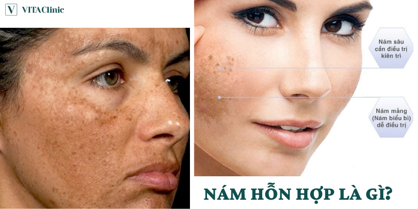 nám hỗn hợp - Image 2