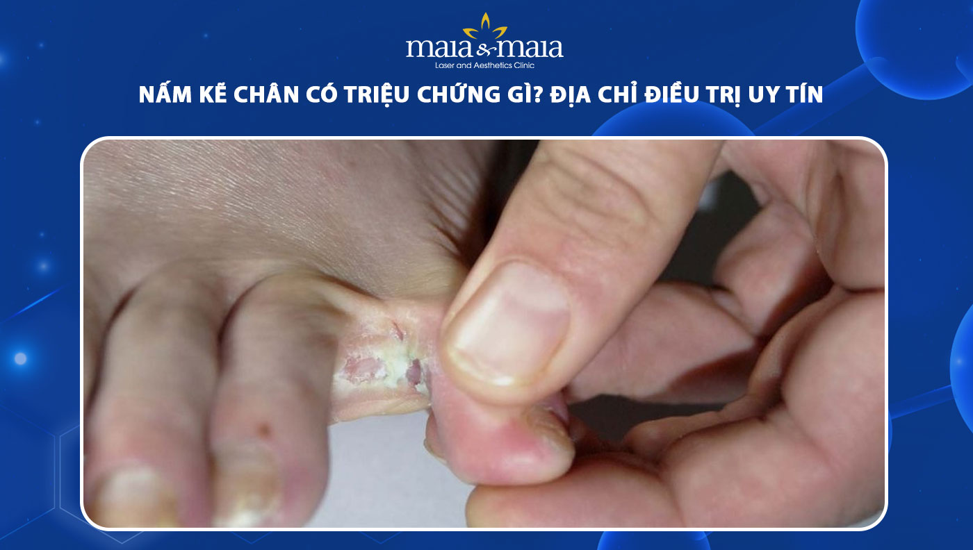 nấm kẽ chân - Image 4