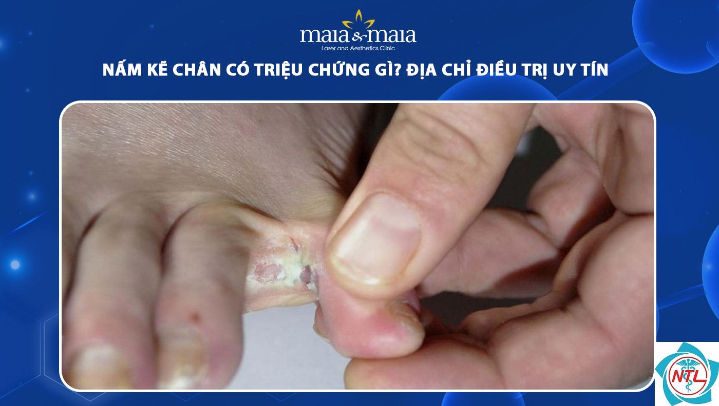 nấm kẽ ngón chân - Image 5