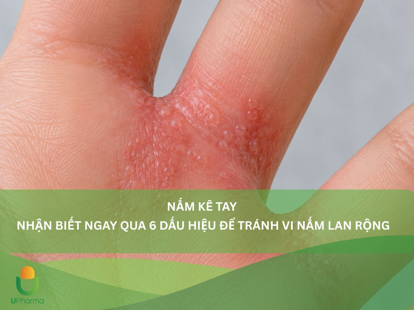 nấm kẽ tay - Image 4