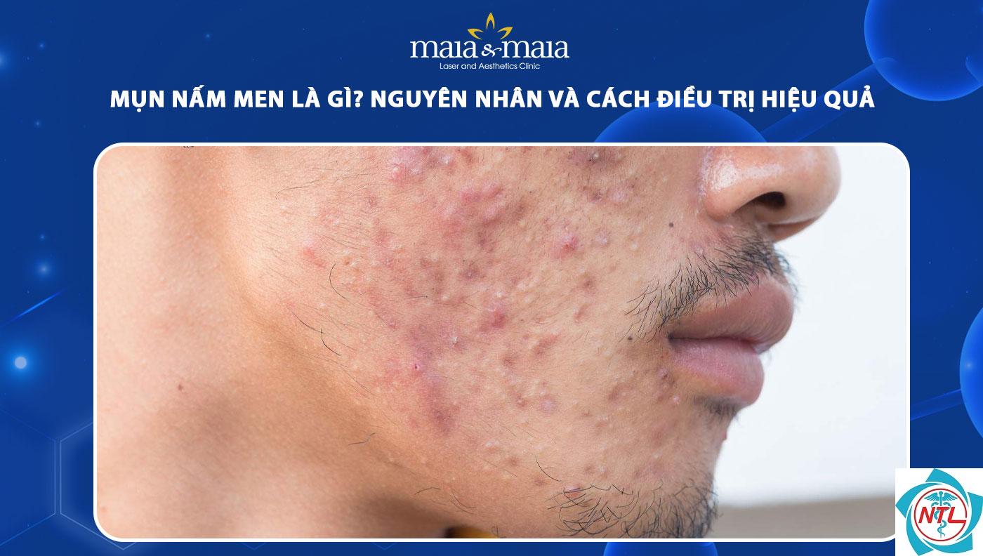 nấm men trên da - Image 3