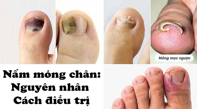 nấm móng chân - Image 2