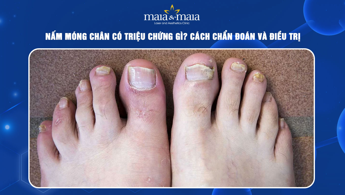 nấm móng chân - Image 4