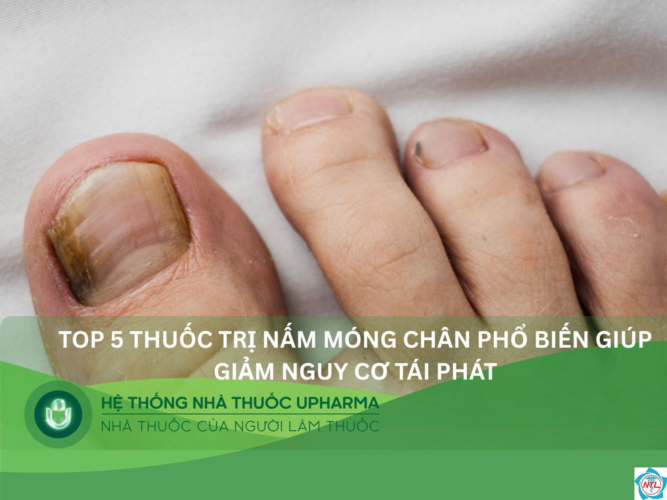 nấm móng chân tái phát - Image 2