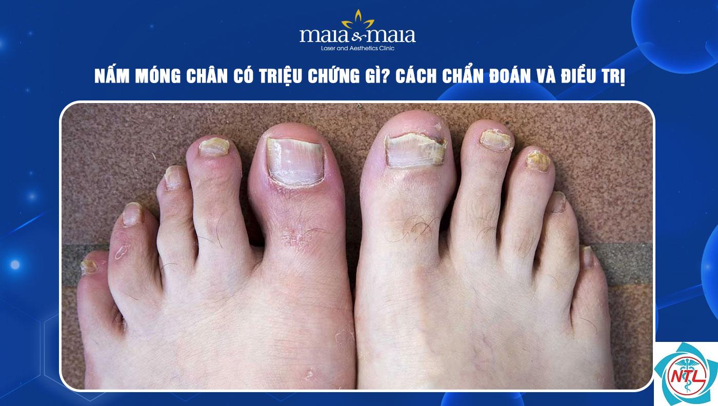 nấm móng chân tái phát - Image 4
