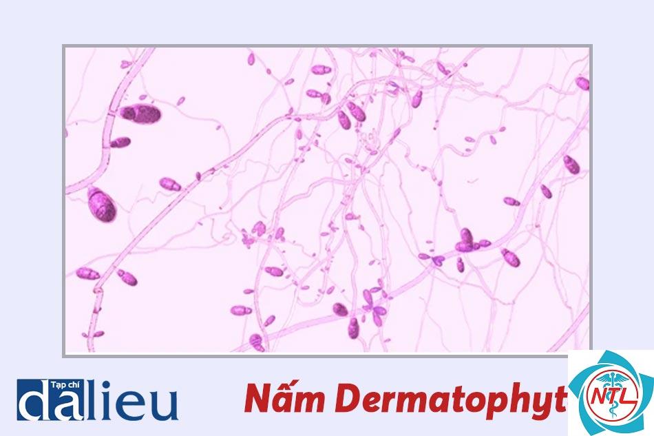 nấm móng do dermatophyte - Image 2