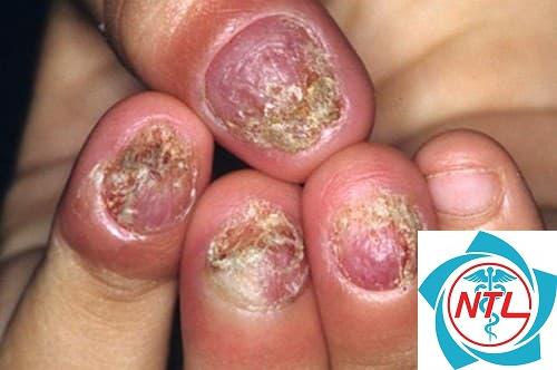 nấm móng do dermatophyte - Image 3