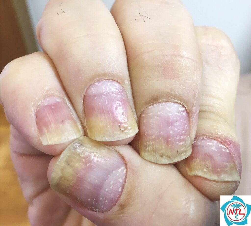 nấm móng do nấm men