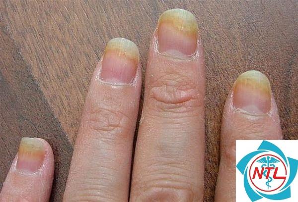 nấm móng nhiều ngón