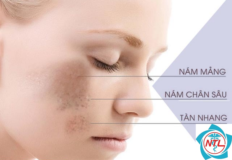 nám nội tiết - Image 2