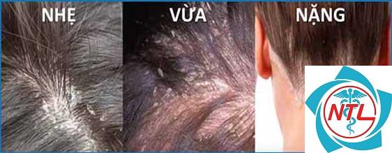 nấm tóc da đầu
