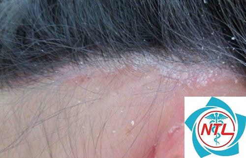 nấm tóc ở người lớn - Image 5