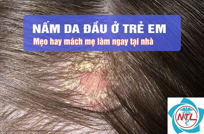 nấm tóc ở trẻ em - Image 5