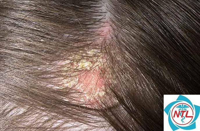 nấm tóc ở trẻ em