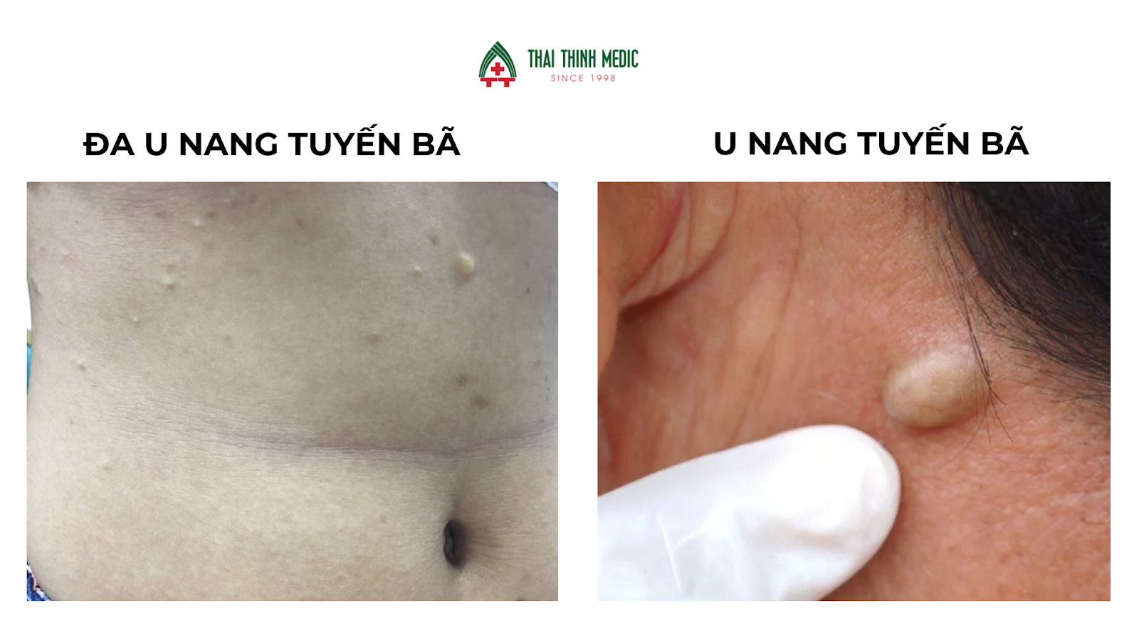 nang bã nhờn dưới da - Image 2