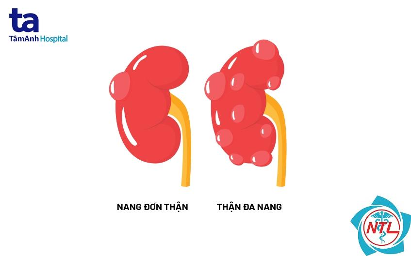 nang thận đơn giản