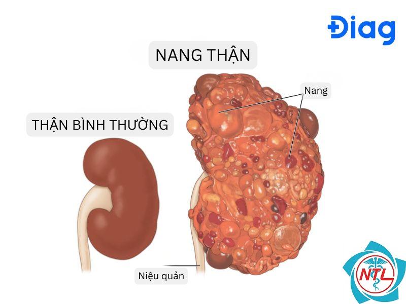 nang thận phức tạp - Image 2