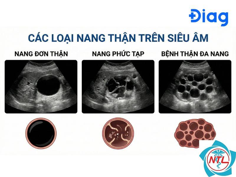 nang thận phức tạp - Image 3