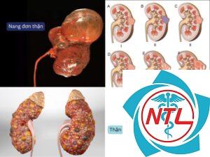 nang thận phức tạp