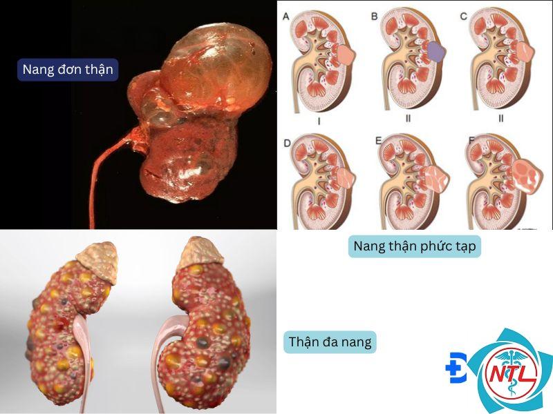 nang thận phức tạp