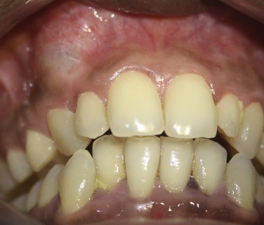 nang xương hàm - Image 2