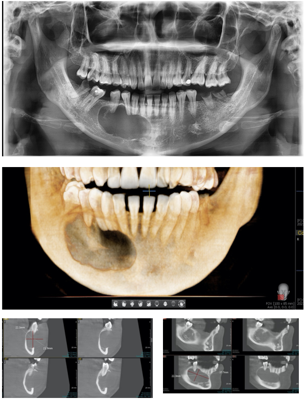 nang xương hàm - Image 3
