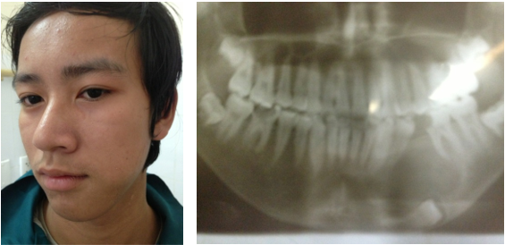 nang xương hàm - Image 4